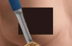 Before and after pictures of breast augmentation with a inframammary fold